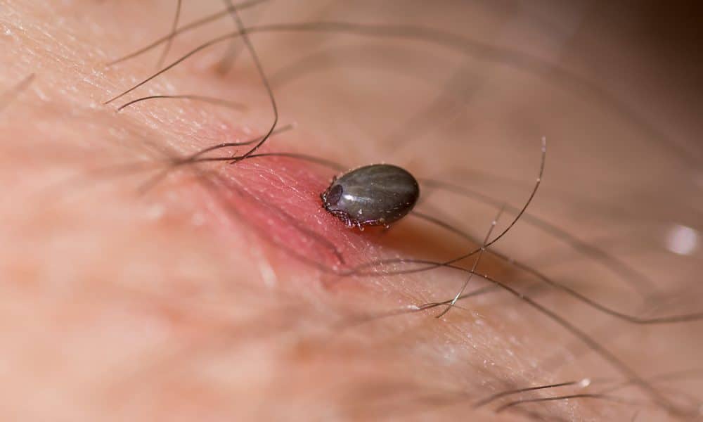 How to Remove a Tick